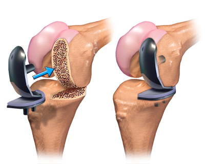 torn knee ligament pcl