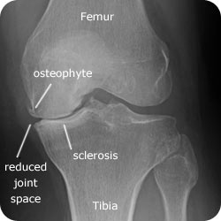 knee-osteoarthritis-joint-space-narrowing