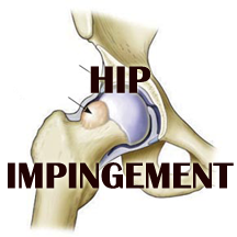 b-hip imping