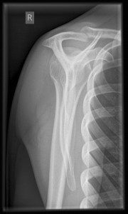 Shoulder Xray Positioning - DOCJOINTS//DR SUJIT JOS//Total joint replacements with the best ...