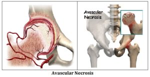 Avacular necrosis of hip joint