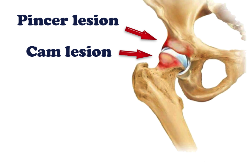 pincer cam hip arthroscopy kochi hip pain DOCJOINTS//DR SUJIT JOS