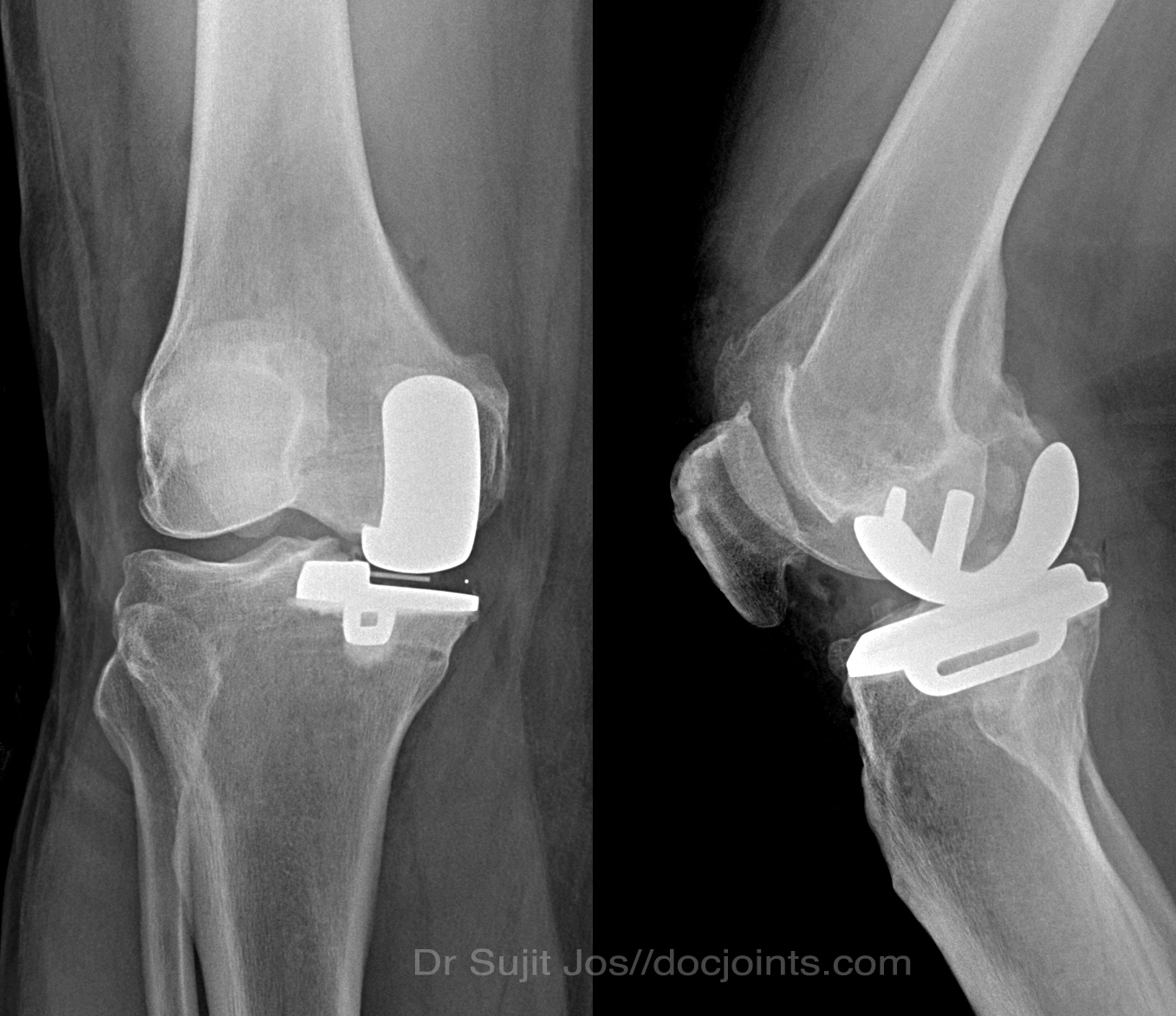 Xray after unicompartmental knee replacement.
