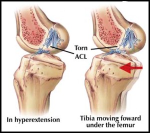 Torn ACL