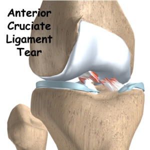 ACL tear