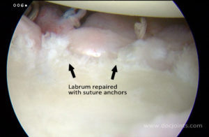 glenoid labrum repaired