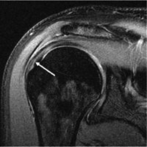 Intact Supraspinatus (rotator cuff) muscle as seen on MRI scan