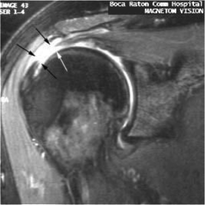 Tear of the  Supraspinatus (rotator cuff) muscle as seen on MRI scan