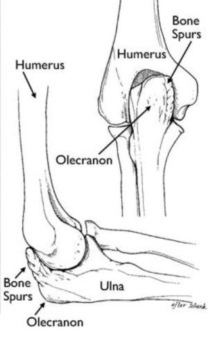 valgus extension overload elbow