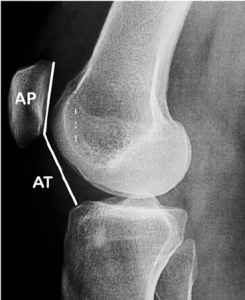 Radiological Measurements in Patellar instability - Docjoints | Dr ...