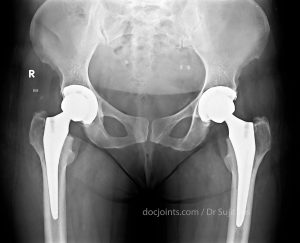 Hip replacement - Dr Sujit Jos