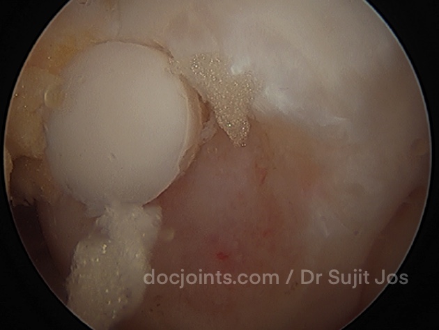 OATS for cartilage lesion