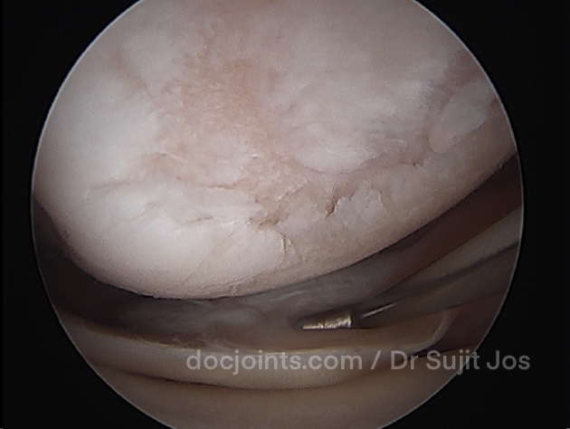 ACL with OATS